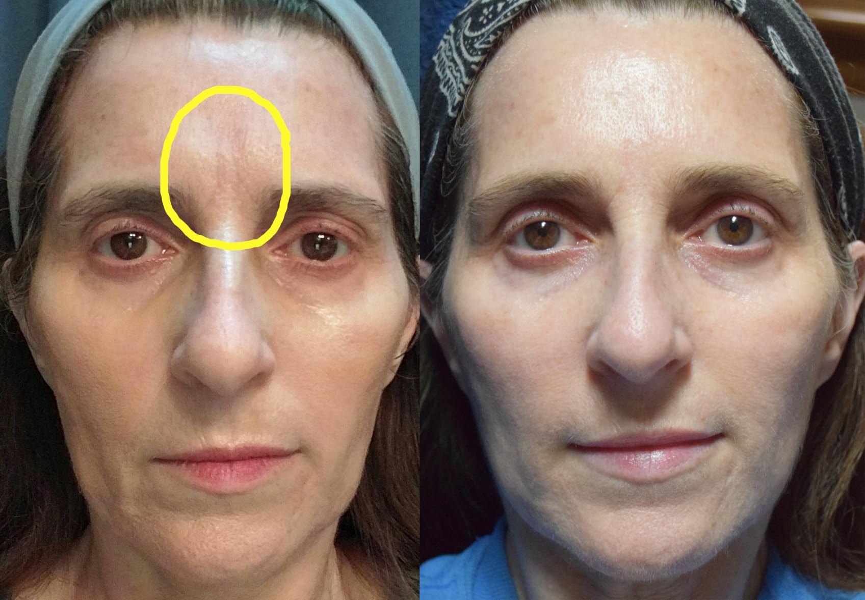 RoC Retinol Correxion Deep Wrinkle Night Cream, 1.0 oz with mineral complex customer photo 1