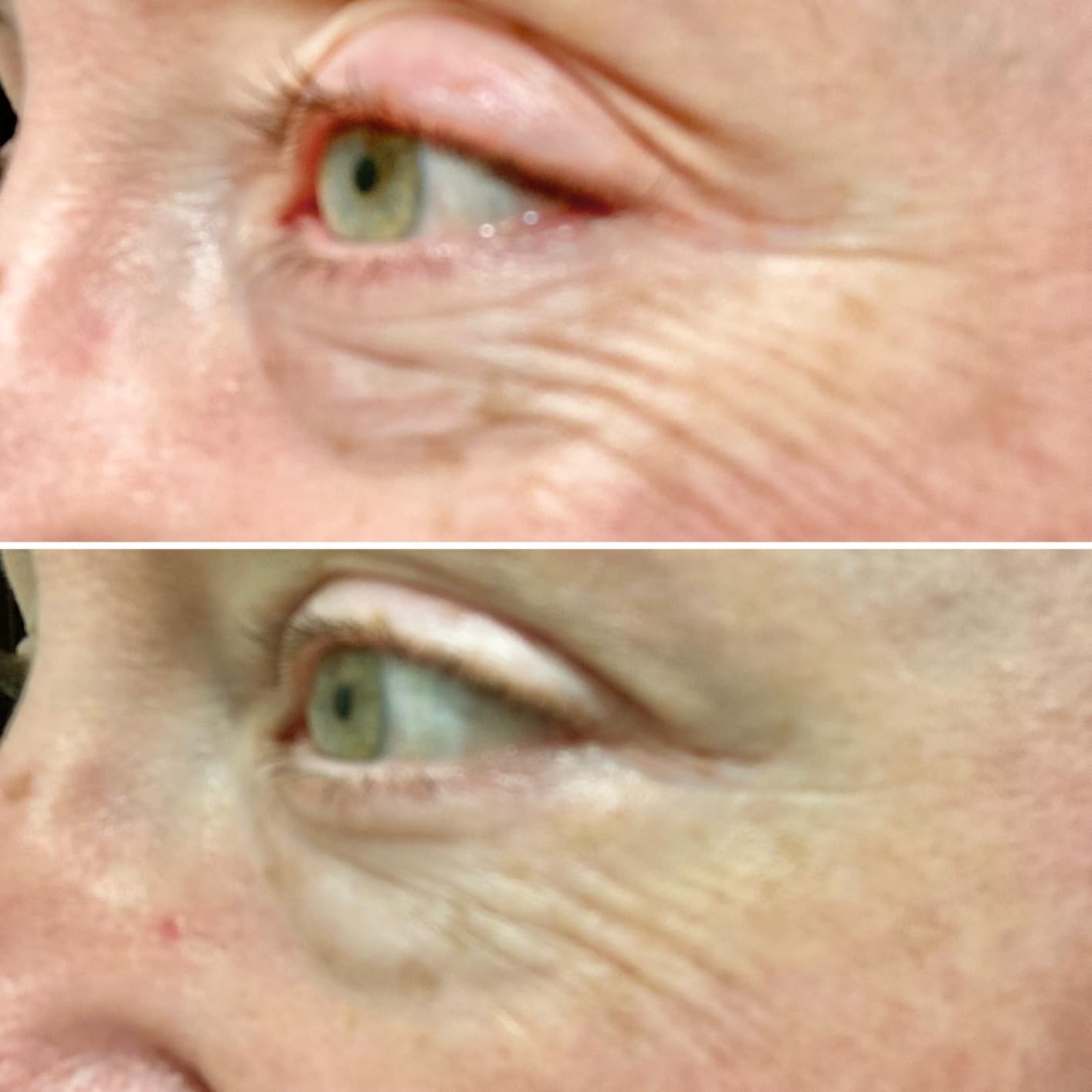 CeraVe Eye Repair Cream, Hyaluronic Acid Eye Cream for Dark Circles, 0.5oz customer photo 1