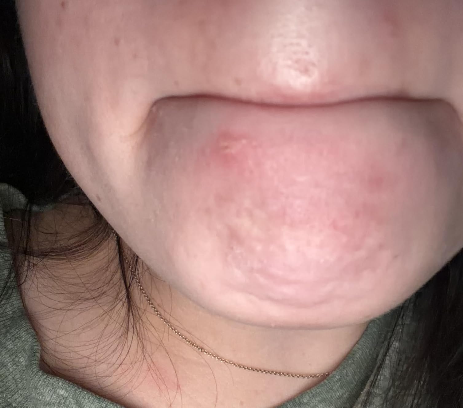 Neutrogena Rapid Clear Stubborn Acne Spot Treatment Gel, 1 oz customer photo 1