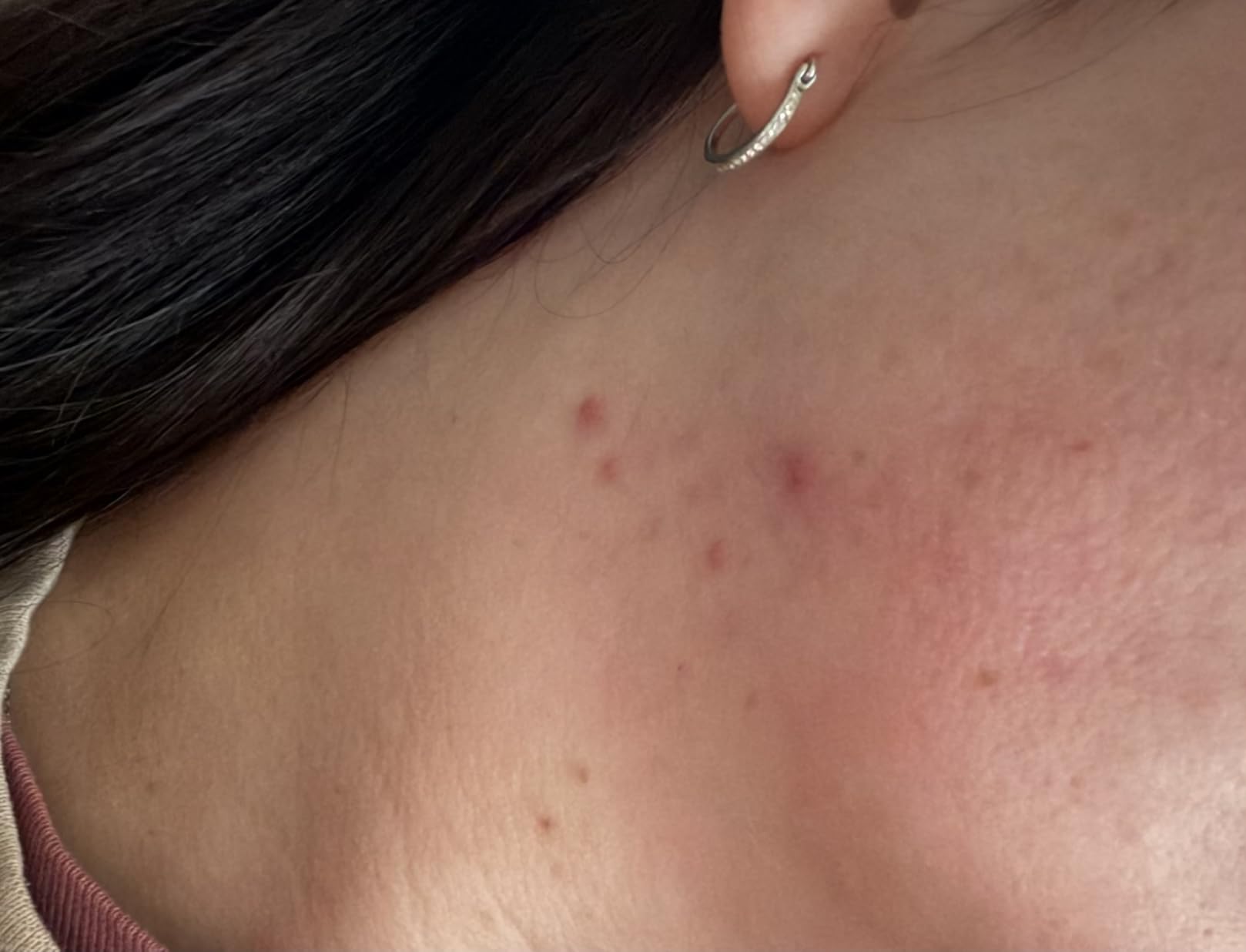 Neutrogena Rapid Clear Stubborn Acne Spot Treatment Gel, 1 oz customer photo 2