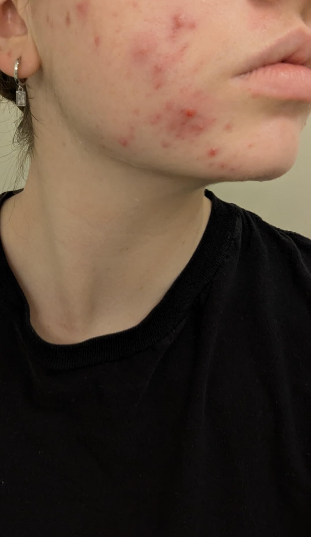 CeraVe Foaming Acne Cream Cleanser, Face Wash with 4% Benzoyl Peroxide, 5oz customer photo 1
