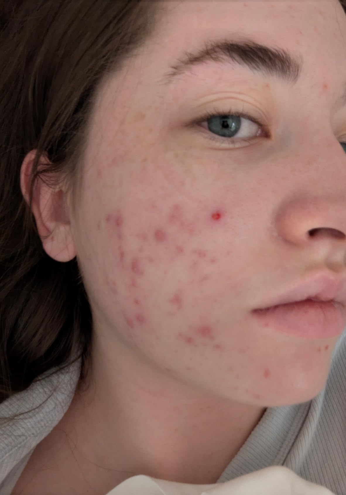 CeraVe Foaming Acne Cream Cleanser, Face Wash with 4% Benzoyl Peroxide, 5oz customer photo 2