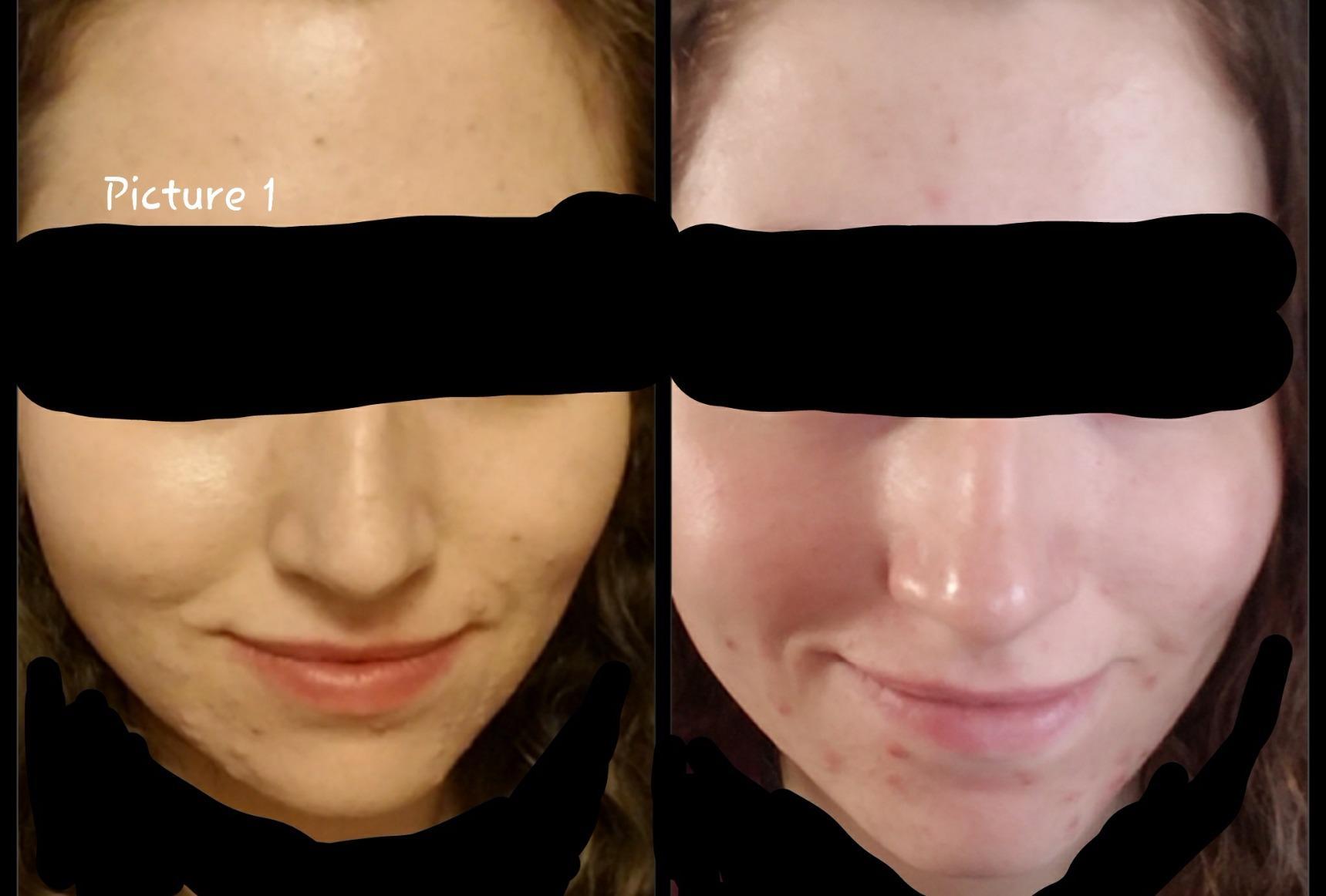 CeraVe Renewing Salicylic Acid Cleanser, Gentle Exfoliating Face Wash, 16oz customer photo 2