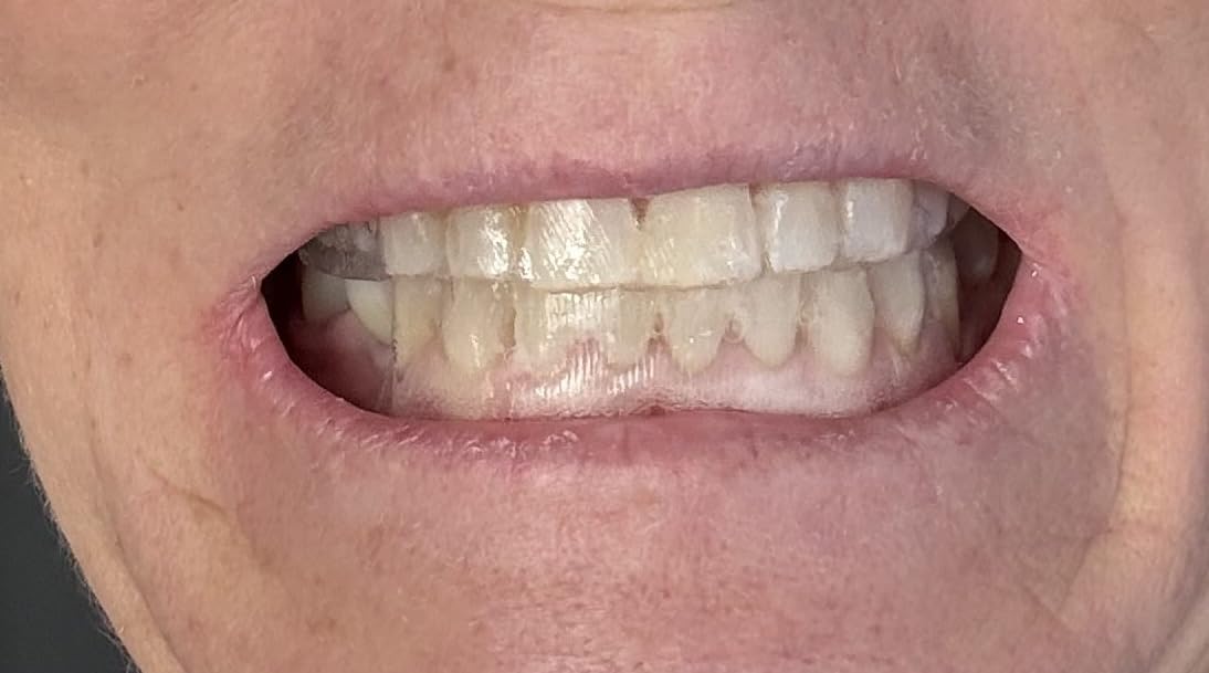 Crest 3DWhitestrips Sensitive White At-Home Teeth Whitening Kit, 18 Treatments, Gently Removes 15 Years of Stains customer photo 1