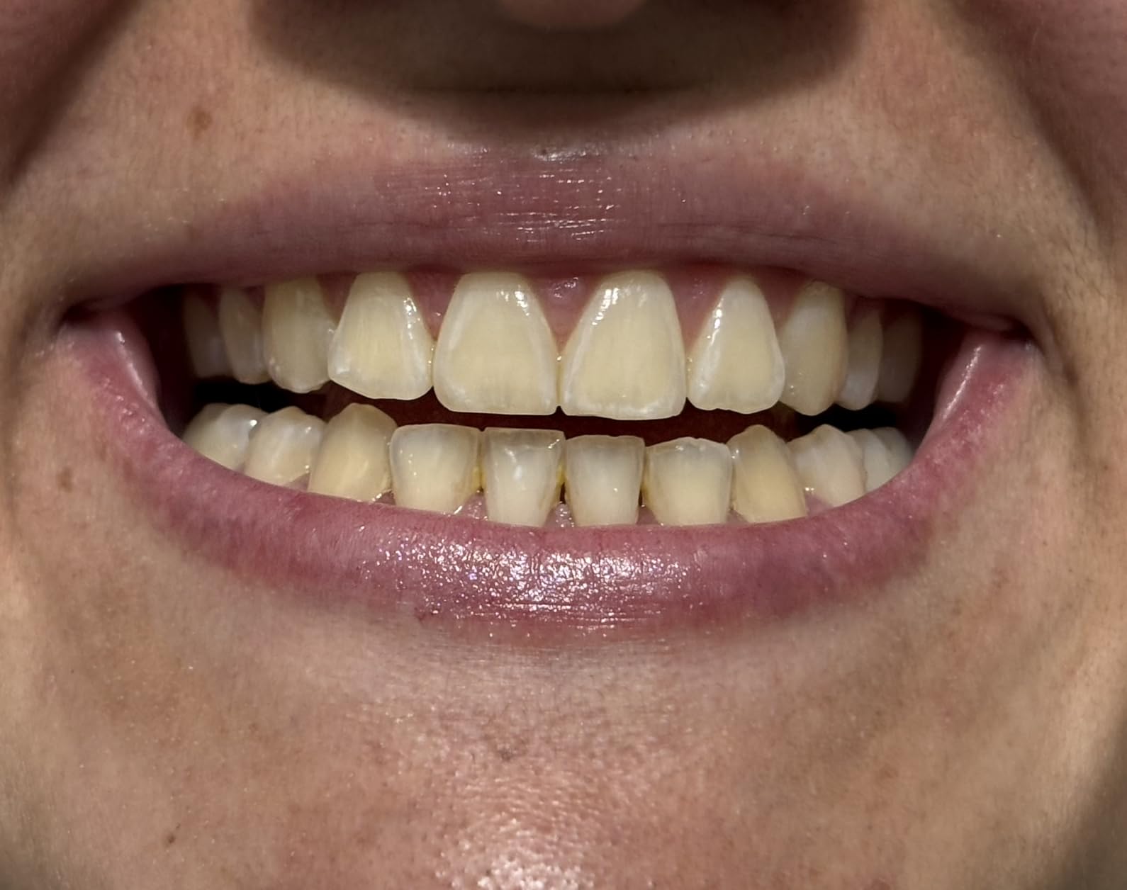 Crest 3DWhitestrips Sensitive White At-Home Teeth Whitening Kit, 18 Treatments, Gently Removes 15 Years of Stains customer photo 2