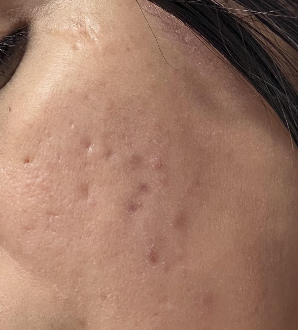 The Ordinary Salicylic Acid 2% Solution, Acne-Fighting Serum for Blemish-Prone Skin customer photo 1
